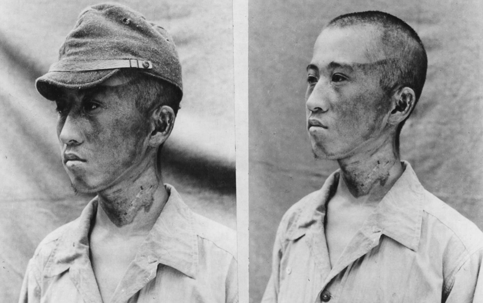 Acest pacient (fotografiat de fortele japoneze pe 2 octombrie 1945) se afla la aproximativ 6500 de picioare de punctul zero cand razele l-au lovit din stanga.  Sapca lui era suficienta pentru a-si proteja partea superioara a capului impotriva arsurilor fulgeratoare.