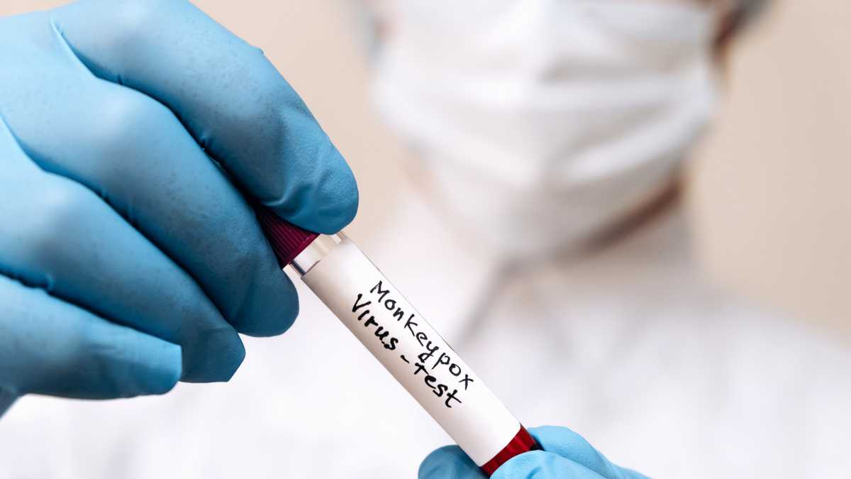 Un lucrator medical tine in maini o eprubeta cu o proba de sange infectata cu virusul variolei maimutei
